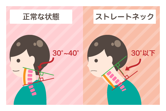 交通事故によるストレートネックとは？診断されたら？