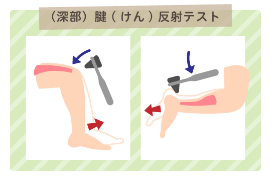 (深部)腱(けん)反射テスト